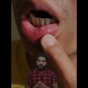 How To Get Rid Of Blisters In Your Mouth Muh Ke Chalay Door Karne Ka